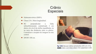 Crânio
Especiais
 Submentovértice (SMV).
 Chassi 24 x 30cm longitudinal.
 RC perpendicular a linha
infraorbitomeatal, centralizado 2 cm
abaixo do nível da sínfise mandibular, ou
no meio das distâncias entre os gônios.
Centralizar o receptor de imagem no raio
central.
 DFOFI 100 cm.
 