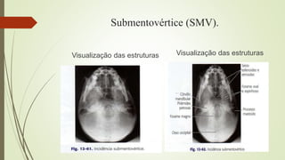 Submentovértice (SMV).
Visualização das estruturas Visualização das estruturas
 