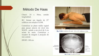 Método De Haas
Chassi: 24 x 30cm, sentido
longitudinal.
RC: formar um ângulo de 25º
cefálicos em relação à LOM.
Centralizar ao plano médio sagital
para passar através do nível dos
MAES , saindo a um nível de 4 cm
acima do nasio. Centralizar o
receptor de imagem à projeção do
raio central.
DFOFI: 100 cm.
 
