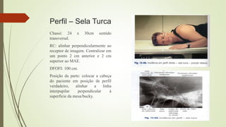Perfil – Sela Turca
Chassi: 24 x 30cm sentido
transversal.
RC: alinhar perpendicularmente ao
receptor de imagem. Centralizar em
um ponto 2 cm anterior e 2 cm
superior ao MAE.
DFOFI: 100 cm.
Posição da parte: colocar a cabeça
do paciente em posição de perfil
verdadeiro, alinhar a linha
interpupilar perpendicular à
superfície da mesa/bucky.
 