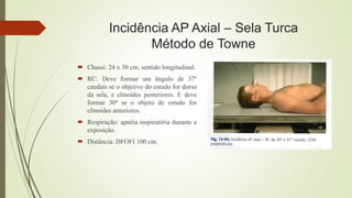 Incidência AP Axial – Sela Turca
Método de Towne
 Chassi: 24 x 30 cm, sentido longitudinal.
 RC: Deve formar um ângulo de 37º
caudais se o objetivo do estudo for dorso
da sela, e clinoides posteriores. E deve
formar 30º se o objeto de estudo for
clinoides anteriores.
 Respiração: apnéia inspiratória durante a
exposição.
 Distância: DFOFI 100 cm.
 