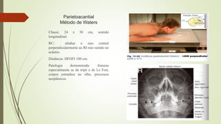 Parietoacantial
Método de Waters
Chassi: 24 x 30 cm, sentido
longitudinal.
RC: alinhar o raio central
perpendicularmente ao RI raio saindo no
acântio.
Distância: DFOFI 100 cm.
Patologia demonstrada: fraturas
especialmente as de tripé e de Le Fort,
corpos estranhos no olho, processos
neoplásicos.
 