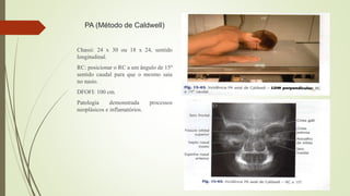 PA (Método de Caldwell)
Chassi: 24 x 30 ou 18 x 24, sentido
longitudinal.
RC: posicionar o RC a um ângulo de 15º
sentido caudal para que o mesmo saia
no nasio.
DFOFI: 100 cm.
Patologia demonstrada processos
neoplásicos e inflamatórios.
 