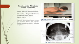 Parietoacantial (Método de
Waters Modificado)
Chassi: 24 x 30 cm sentido longitudinal.
RC: alinhar o RC perpendicularmente
centrado para sair no acântio.
DFOFI: 100 cm.
Patologia demonstrada: fraturas orbitais
por exemplo: fraturas por explosão,
corpos estranhos no olho, e processos
neoplásicos.
 