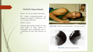 Perfil De Ossos Nasais
Chassi: 18 x 24 cm sentido transversal.
RC: alinhar perpendicularmente ao
receptor de imagem. Centralizar o RC
1,25 cm abaixo do násio.
DFOFI: 100 cm.
Patologia demonstrada: fraturas do osso
nasal ambos os lados devem ser
examinados para comparação com a
visualização do lado mais próximo ao
RI.
 