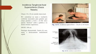Incidência Tangêncial Axial
Superoinferior (Ossos
Nasais).
Chassi: 18 x 24 cm sentido transversal.
RC: centralizar no nasio e incliná-lo
conforme necessário para garantir que
esteja paralelo a LGA. ( O RC deve
apenas “deslizar” sobre a glabela e os
dentes frontais superiores).
DFOFI: 100 cm.
Patologia demonstrada: fratura de osso
nasal, e deslocamento mediolateral
septal.
 
