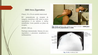 SMV Arco Zigomático
Chassi: 18 x 24 cm sentido transversal.
RC: perpendicular ao receptor de
imagem, centralizar o RC entre os arcos
zigomáticos 4 cm inferior à sínfise
mandibular. Liom paralela ao plano do
receptor.
DFOFI: 100 cm.
Patologia demonstrada: fraturas de arco
zigomático e processos neoplásicos e
insflamatórios.
 