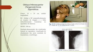 Obliqua Inferossuperior
(Tangencial) Arcos
Zigomáticos
Chassi: 18 x 24 cm, sentido
longitudinal.
RC: Alinhar o RC perpendicularmente
ao receptor de imagem e a linha
infraorbitomeatal. Centralizar no
zigomático de interesse.
DFOFI: 100 cm.
Patologia demonstrada: são visualizadas
fraturas no zigomático, visualização de
afundamento dos arcos resultante de
traumatismo, e morfologia.
 