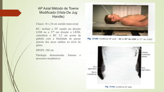 AP Axial Método de Towne
Modificado (Vista De Jug
Handle)
Chassi: 18 x 24 cm sentido transversal.
RC: inclinar a 30º caudal em direção
LOM ou a 37º em direção a LIOM,
centralizar o RC 2,5 cm acima da
glabela com a finalidade de passar
através dos arcos médios ao nível do
gônio.
DFOFI: 100 cm.
Patologia demonstrada: fraturas e
processos neoplásicos.
 