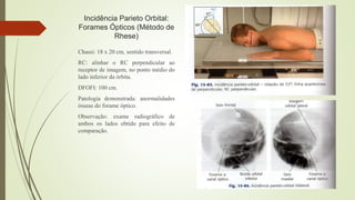Incidência Parieto Orbital:
Forames Ópticos (Método de
Rhese)
Chassi: 18 x 20 cm, sentido transversal.
RC: alinhar o RC perpendicular ao
receptor de imagem, no ponto médio do
lado inferior da órbita.
DFOFI: 100 cm.
Patologia demonstrada: anormalidades
ósseas do forame óptico.
Observação: exame radiográfico de
ambos os lados obtido para efeito de
comparação.
 