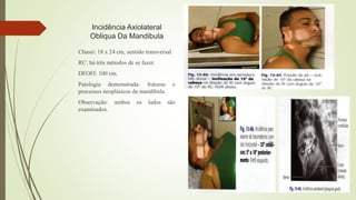 Incidência Axiolateral
Obliqua Da Mandibula
Chassi: 18 x 24 cm, sentido transversal.
RC: há três métodos de se fazer.
DFOFI: 100 cm.
Patologia demonstrada: fraturas e
processos neoplásicos da mandíbula.
Observação: ambos os lados são
examinados.
 