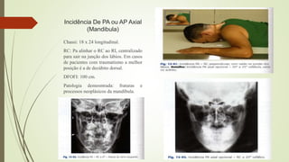 Incidência De PA ou AP Axial
(Mandibula)
Chassi: 18 x 24 longitudinal.
RC: Pa alinhar o RC ao RI, centralizado
para sair na junção dos lábios. Em casos
de pacientes com traumatismo a melhor
posição é a de decúbito dorsal.
DFOFI: 100 cm.
Patologia demosntrada: fraturas e
processos neoplásicos da mandíbula.
 