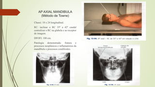 AP AXIAL MANDIBULA
(Método de Towne)
Chassi: 18 x 24 longitudinal.
RC: inclinar o RC 35º a 42º caudal
centralizar o RC na glabela e ao receptor
de imagem.
DFOFI: 100 cm.
Patologia demonstrada: fratura e
processos neoplásicos e inflamatórios da
mandíbula e processos condiloides.
 