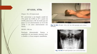 AP AXIAL ATMs
Chassi: 18 x 24 transversal.
RC: posicionar a um ângulo caudal de
35ºa partir da LOM ou 42º a partir de
LIOM, direcionar o RC de modo que ele
passe 2,5 cm anteriormente ao nível das
ATMs 5 cm antes anteriormente aos
MAEs.
DFOFI: 100 cm.
Patologia demonstrada: fratura, a
amplitude de movimento anormal entre
o côndilo e a fossa temporo mandibular.
 
