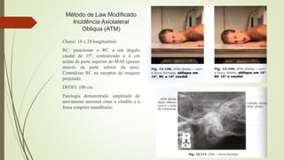 Método de Law Modificado
Incidência Axiolateral
Obliqua (ATM)
Chassi: 18 x 24 longitudinal.
RC: posicionar o RC a um ângulo
caudal de 15º, centralizado a 4 cm
acima da parte superior do MAE (passar
através da parte inferor da atm).
Centralizar RC no receptor de imagem
projetado.
DFOFI: 100 cm.
Patologia demonstrada: amplitude de
movimento anormal entre o côndilo e a
fossa temporo mandibular.
 