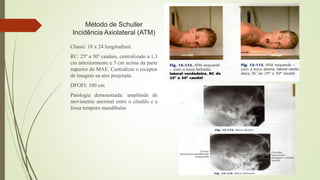 Método de Schuller
Incidência Axiolateral (ATM)
Chassi: 18 x 24 longitudinal.
RC: 25º a 30º caudais, centralizado a 1,3
cm anteriormente e 5 cm acima da parte
superior do MAE. Centralizar o receptor
de imagem na atm projetada.
DFOFI: 100 cm.
Patologia demonstrada: amplitude de
movimento anormal entre o côndilo e a
fossa temporo mandibular.
 