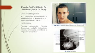 Posição Em Perfil Direito Ou
Esquerdo ( Seios Da Face)
Chassi: 18 x 24 longitudinal.
RC: centralizado horizontalmente e
perpendicular ao RI. Centralizar o RC
entre o canto externo e o MAE.
DFOFI: 100 cm.
Patologia demonstrada: Patologia
demonstrada: condições inflamatórias
(sinusite, osteomielite secundária) e
pólipos nos seios da face.
 