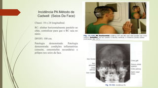 Incidência PA Método de
Cadwell (Seios Da Face)
Chassi: 18 x 24 longitudinal.
RC: alinhar horizontalmente paralelo ao
chão, centralizar para que o RC saia no
násio.
DFOFI: 100 cm.
Patologia demonstrada: Patologia
demonstrada: condições inflamatórias
(sinusite, osteomielite secundária) e
pólipos nos seios da face.
 
