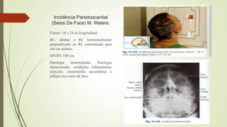 Incidência Parietoacantial
(Seios Da Face) M. Waters.
Chassi: 18 x 24 na longitudinal.
RC: alinhar o RC horizontalmente
perpendicular ao RI, centralizado para
sair no acântio.
DFOFI: 100 cm.
Patologia demonstrada: Patologia
demonstrada: condições inflamatórias
(sinusite, osteomielite secundária) e
pólipos nos seios da face.
 