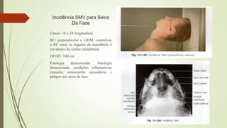 Incidência SMV para Seios
Da Face
Chassi: 18 x 24 longitudinal.
RC: perpendicular a LIOM, centralizar
o RC entre os ângulos da mandibula 4
cm abaixo da sínfise mandibular.
DFOFI: 100 cm.
Patologia demonstrada: Patologia
demonstrada: condições inflamatórias
(sinusite, osteomielite secundária) e
pólipos nos seios da face.
 