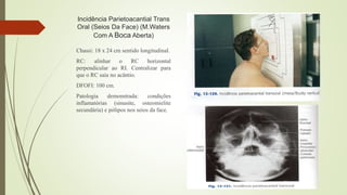 Incidência Parietoacantial Trans
Oral (Seios Da Face) (M.Waters
Com A Boca Aberta)
Chassi: 18 x 24 cm sentido longitudinal.
RC: alinhar o RC horizontal
perpendicular ao RI. Centralizar para
que o RC saia no acântio.
DFOFI: 100 cm.
Patologia demonstrada: condições
inflamatórias (sinusite, osteomielite
secundária) e pólipos nos seios da face.
 