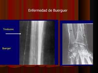Enfermedad de Buerguer 