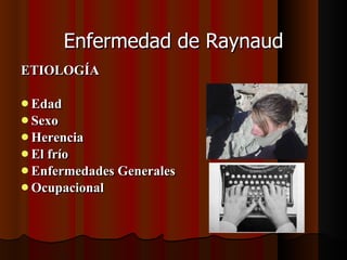 Enfermedad de Raynaud ETIOLOGÍA Edad  Sexo Herencia El frío Enfermedades Generales Ocupacional 