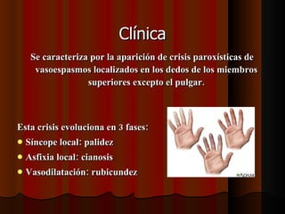 Clínica Se caracteriza por la aparición de crisis paroxísticas de vasoespasmos localizados en los dedos de los miembros superiores excepto el pulgar. Esta crisis evoluciona en 3 fases: Síncope local: palidez Asfixia local: cianosis Vasodilatación: rubicundez 