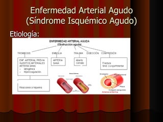 Etiología: Enfermedad Arterial Agudo (Síndrome Isquémico Agudo) 