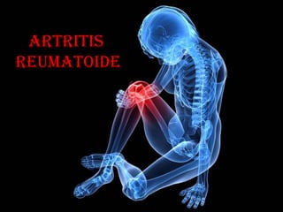 Artritis
Artritis
reumAtoide
reumAtoide
 