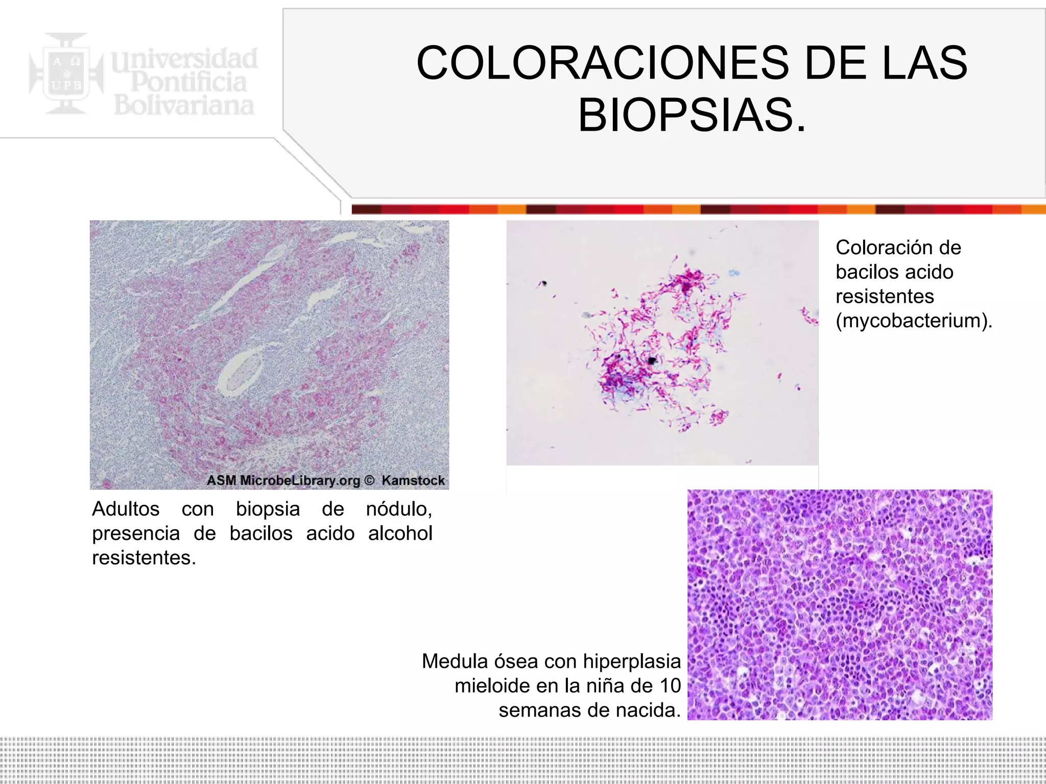 COLORACIONES DE LAS BIOPSIAS. Adultos con biopsia de nódulo, presencia de bacilos acido alcohol resistentes. Medula ósea con hiperplasia mieloide en la niña de 10 semanas de nacida. Coloración de bacilos acido resistentes (mycobacterium). 