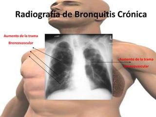 Bronquitis aguda y crónica | PPTX