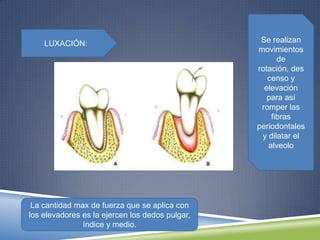 LUXACIÓN: Se realizan
movimientos
de
rotación, des
censo y
elevación
para así
romper las
fibras
periodontales
y dilatar el
alveolo
La cantidad max de fuerza que se aplica con
los elevadores es la ejercen los dedos pulgar,
índice y medio.
 