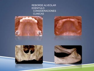 REBORDE ALVEOLAR
EDENTULO
CONSIDERACIONES
CLINICAS
 