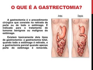 O QUE É A GASTRECTOMIA?
A gastrectomia é o procedimento
cirúrgico que consiste na retirada de
parte ou de todo o estômago. É
indicada para o tratamento de
tumores benignos ou malignos do
estômago.
Existem basicamente dois tipos
de gastrectomia: a gastrectomia total,
quando todo o estômago é retirado, e
a gastrectomia parcial quando apenas
parte do estômago é removida.
 