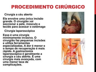 PROCEDIMENTO CIRÚRGICO
Cirurgia a céu aberto
Ela envolve uma única incisão
grande. O cirurgião vai
seccionar a pele, músculo e
tecido para acessar o estômago
Cirurgia laparoscópica
Essa é uma cirurgia
minimamente invasiva. O
cirurgião faz pequenas incisões
e utiliza ferramentas
especializadas. A dor é menor e
o tempo de recuperação é mais
rápido. A gastrectomia
laparoscópica é geralmente a
cirurgia a céu aberto. É uma
cirurgia mais avançada, com
uma menor taxa de
complicações.
 
