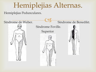 
Hemiplejias Alternas.
Hemiplejias Pedunculares.
Síndrome de Weber. Síndrome de Benedikt.
Síndrome Foville.
Superior
 