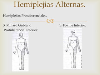 
Hemiplejias Alternas.
Hemiplejias Protuberenciales.
S. Millard Gubler o S. Foville Inferior.
Protuberencial Inferior
 