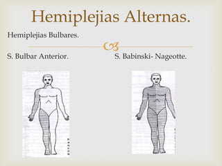 
Hemiplejias Alternas.
Hemiplejias Bulbares.
S. Bulbar Anterior. S. Babinski- Nageotte.
 