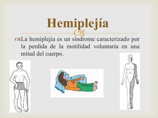 
Hemiplejía
La hemiplejia es un síndrome caracterizado por
la perdida de la motilidad voluntaria en una
mitad del cuerpo.
 