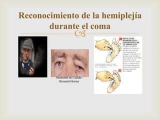 
Reconocimiento de la hemiplejía
durante el coma
Síndrome de Claude-
Bernard-Horner
 