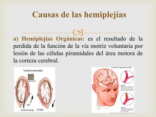 
Causas de las hemiplejías
a) Hemiplejías Orgánicas: es el resultado de la
perdida de la función de la vía motriz voluntaria por
lesión de las células piramidales del área motora de
la corteza cerebral.
 