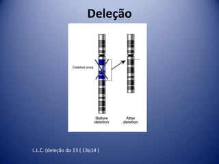 Deleção
L.L.C. (deleção do 13 ( 13q14 )
 