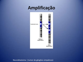 Amplificação
Neuroblastoma ( tumor de gânglios simpáticos)
 