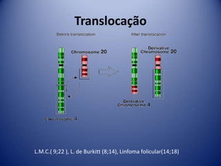 Translocação
L.M.C.( 9;22 ), L. de Burkitt (8;14), Linfoma folicular(14;18)
 