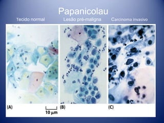 Papanicolau
Tecido normal Lesão pré-maligna Carcinoma invasivo
 