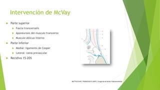 Mcvay Incision hernia inguinal y crural | PPTX