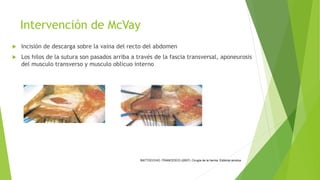 Mcvay Incision hernia inguinal y crural | PPTX