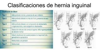 Clasificaciones de hernia inguinal
 
