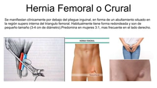 Hernia Femoral o Crural
Se manifiestan clínicamente por debajo del pliegue inguinal, en forma de un abultamiento situado en
la región supero interna del triangulo femoral. Habitualmente tiene forma redondeada y son de
pequeño tamaño (3-4 cm de diámetro).Predomina en mujeres 3:1, mas frecuente en el lado derecho.
 
